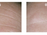 Age Cure, Foto 1