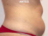 Tratamiento Anticelultico o Reafirmante, Foto 1