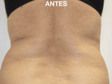 Tratamiento Anticelultico o Reafirmante, Foto 2