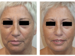 Laser de Diodo